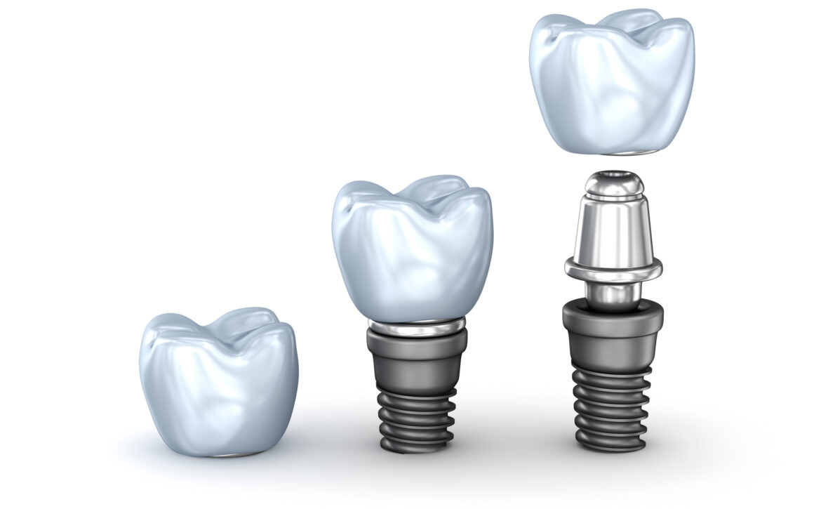 Tooth Implants set isolated on white background 3D illustration