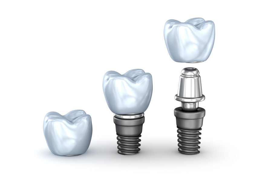 Tooth Implants set isolated on white background 3D illustration