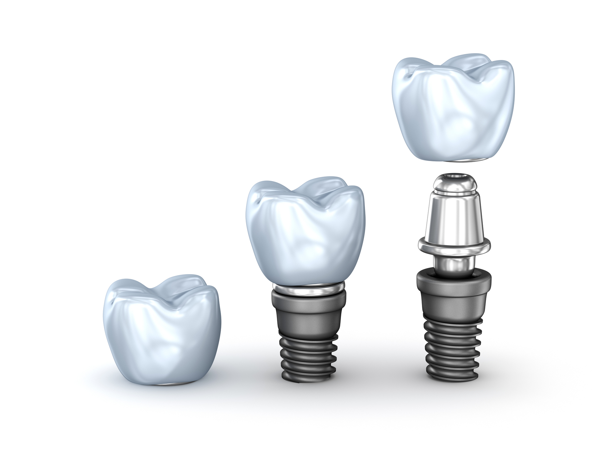 Tooth Implants set isolated on white background 3D illustration