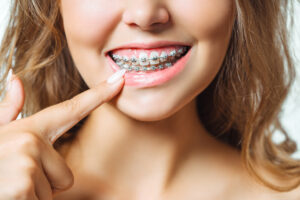 Apparecchi per i denti