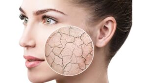 pelle secca - Clinica Polispecialistica Marciano pelle secca