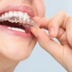 Invisalign: alla scoperta dell’innovativo apparecchio invisibile