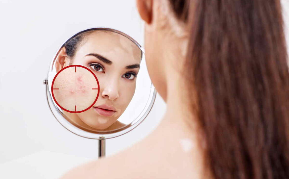 Young woman with acne skin in red aim.