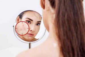 Acne e punti neri