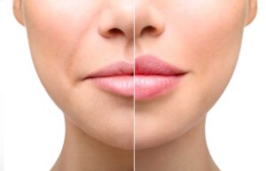 Filler labbra medicina estetica