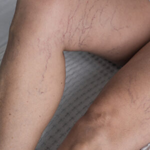 Chirurgia vascolare e Laser terapia